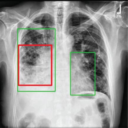 AI Model for Pneumonia Detection